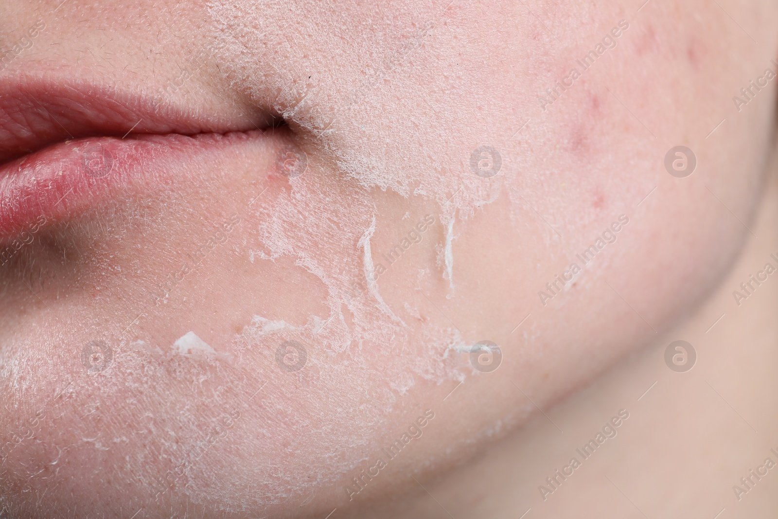 Photo of Woman with dry skin on face, closeup