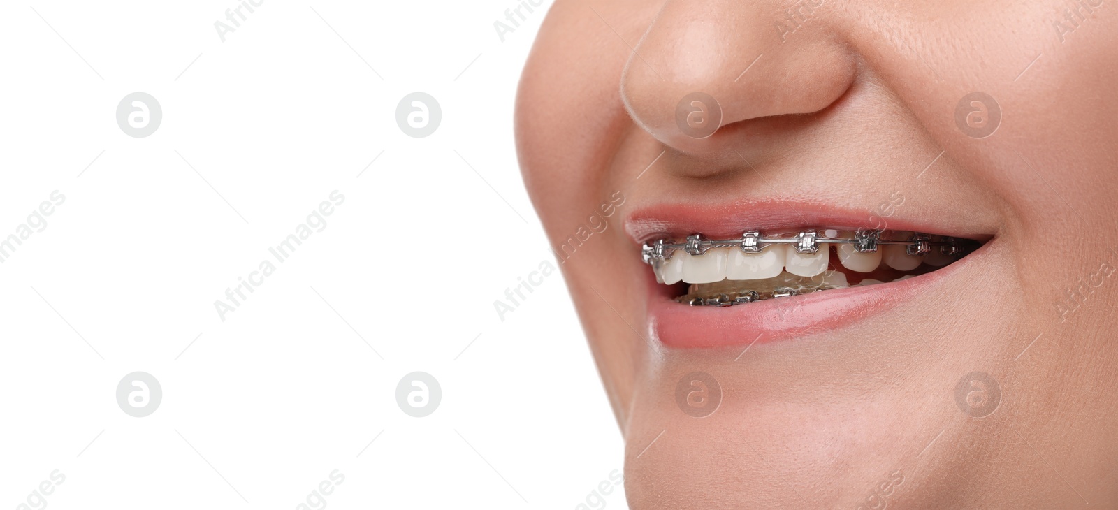 Image of Smiling woman with braces on white background, closeup. Banner design with space for text