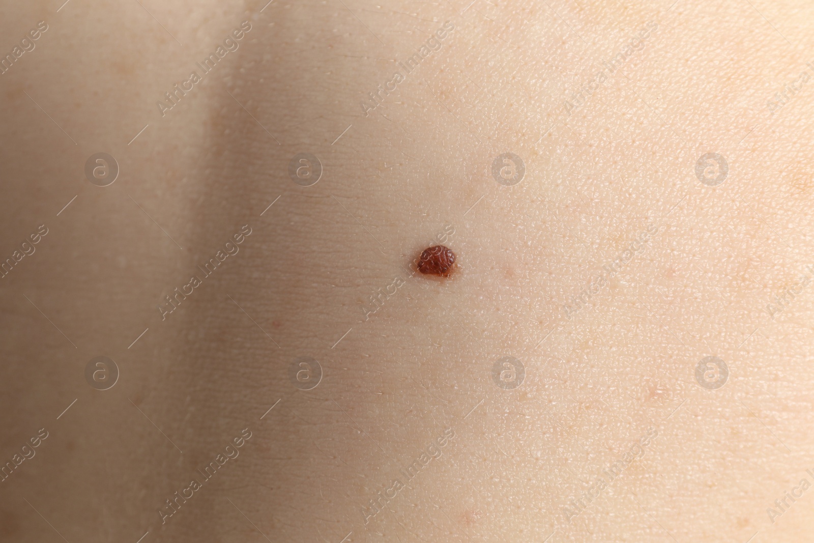 Photo of Closeup view of woman's body with birthmarks as background