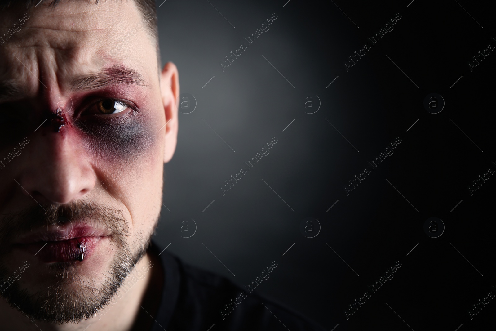 Photo of Closeup view of man with facial injuries on dark background, space for text. Domestic violence victim