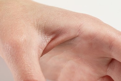 Photo of Little boy with dry skin on hand, closeup