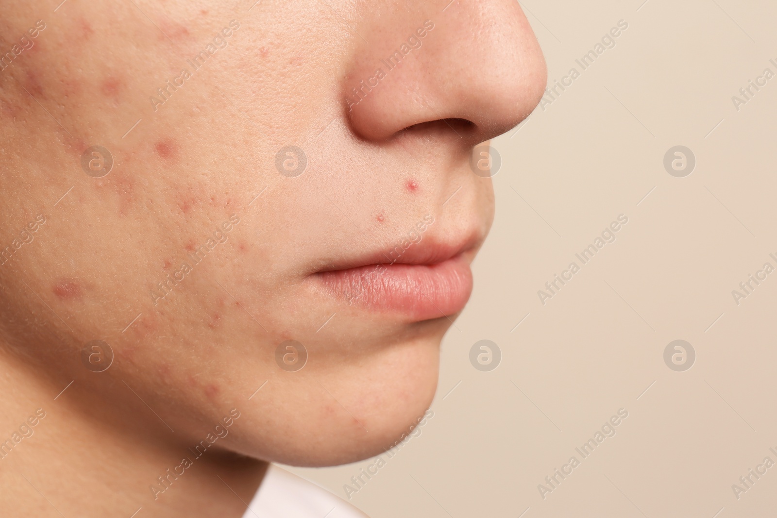 Photo of Teen guy with acne problem on beige background, closeup