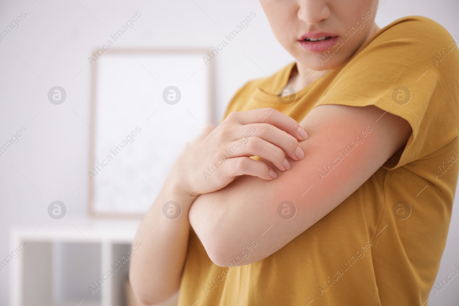 Photo of Woman scratching arm indoors, closeup with space for text. Allergy symptoms