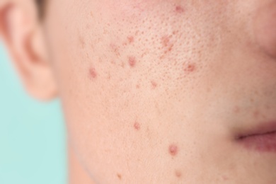 Photo of Young man with acne problem, closeup
