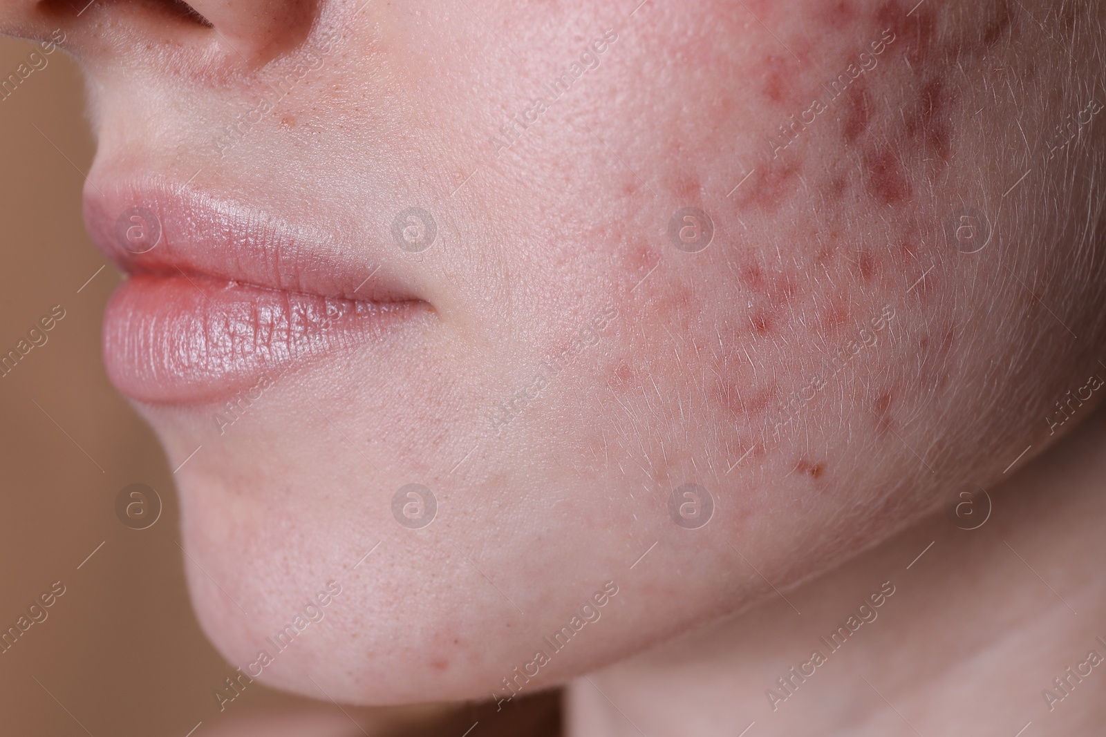 Photo of Young woman with acne problem on beige background, closeup