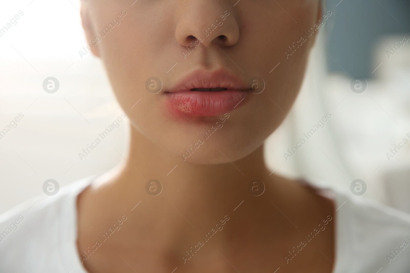 Photo of Woman with herpes on lip against blurred background, closeup