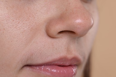 Photo of Closeup view of woman with blackheads on her nose against beige background