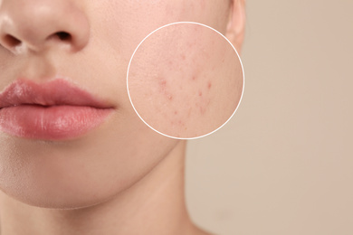 Image of Teenage girl with acne problem on beige background, closeup