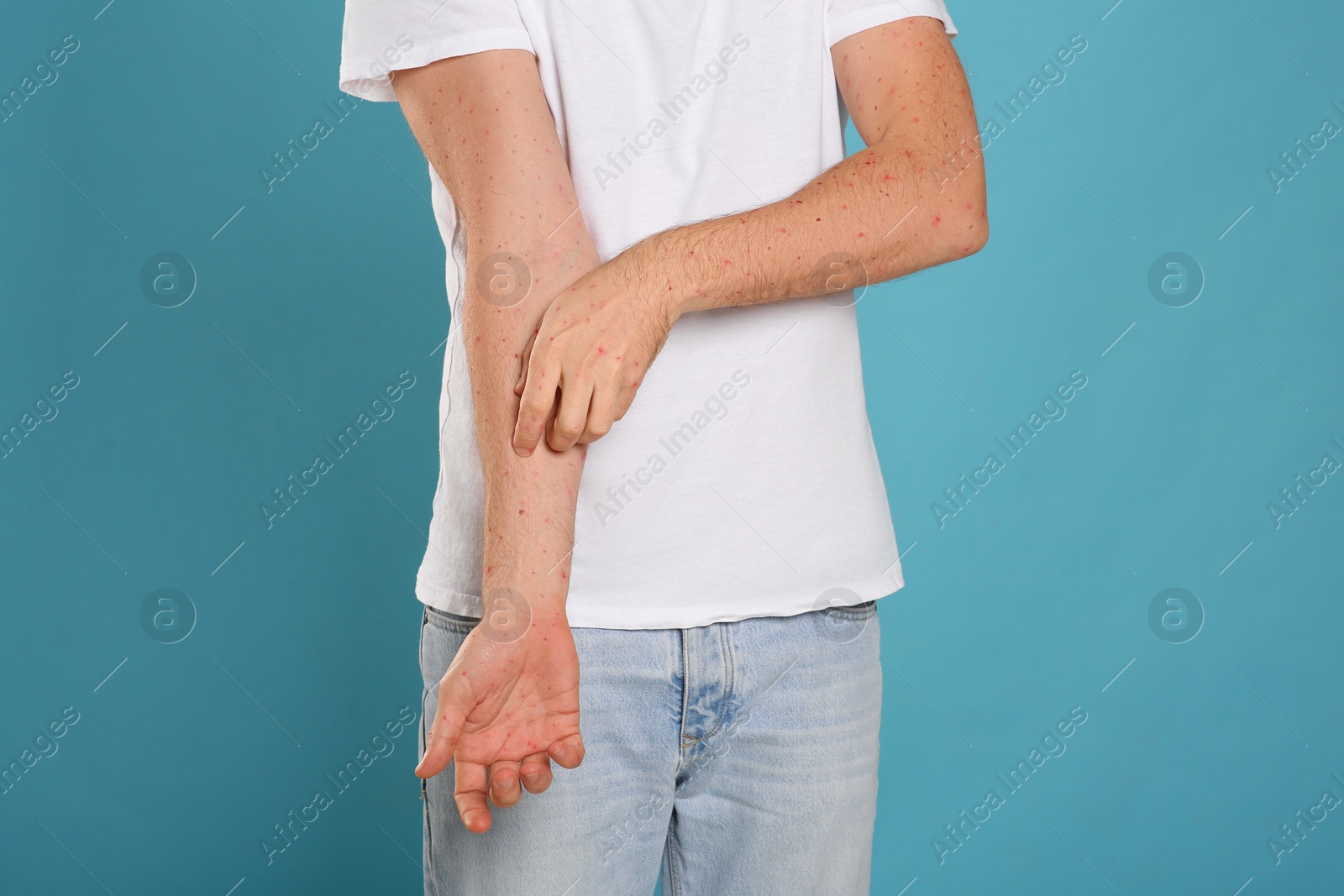 Photo of Man with rash suffering from monkeypox virus on light blue background, closeup