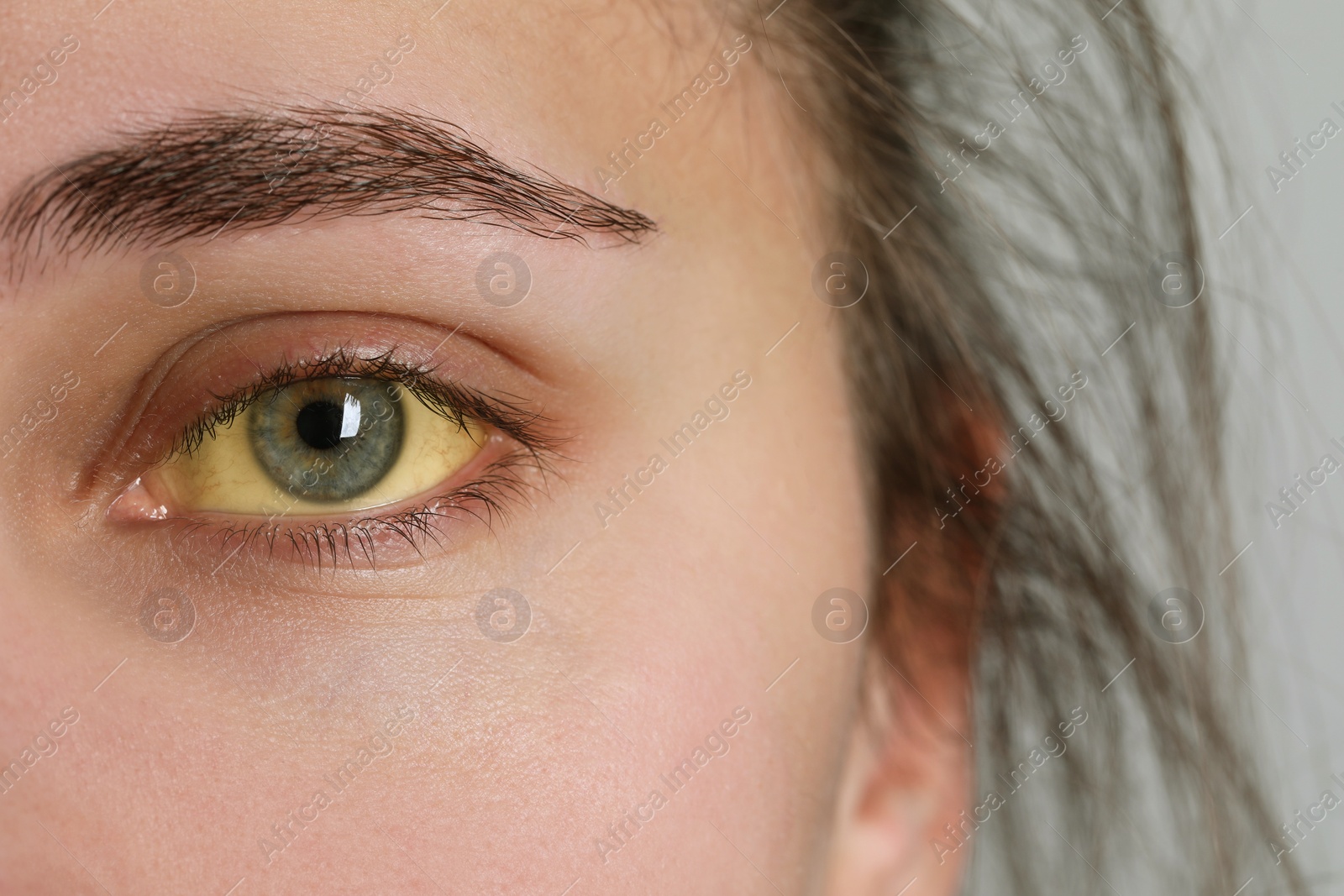 Photo of Woman with yellow eyes on light background, closeup. Symptom of hepatitis