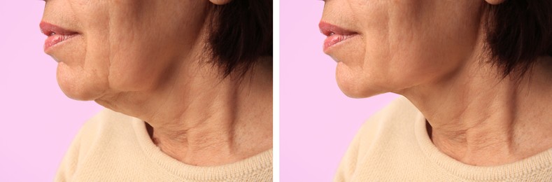 Image of Double chin problem. Collage with photos of mature woman before and after skin tightening treatments on pink background, closeup