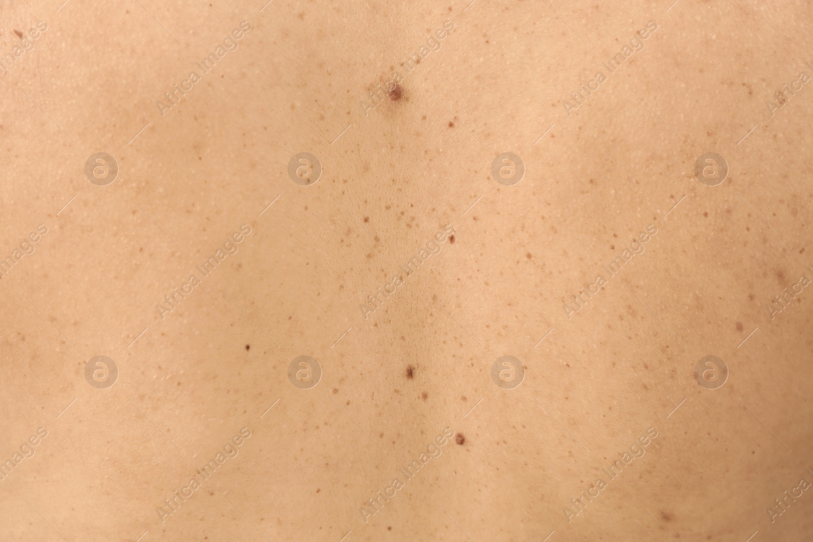 Photo of Closeup of woman's body with birthmarks as background