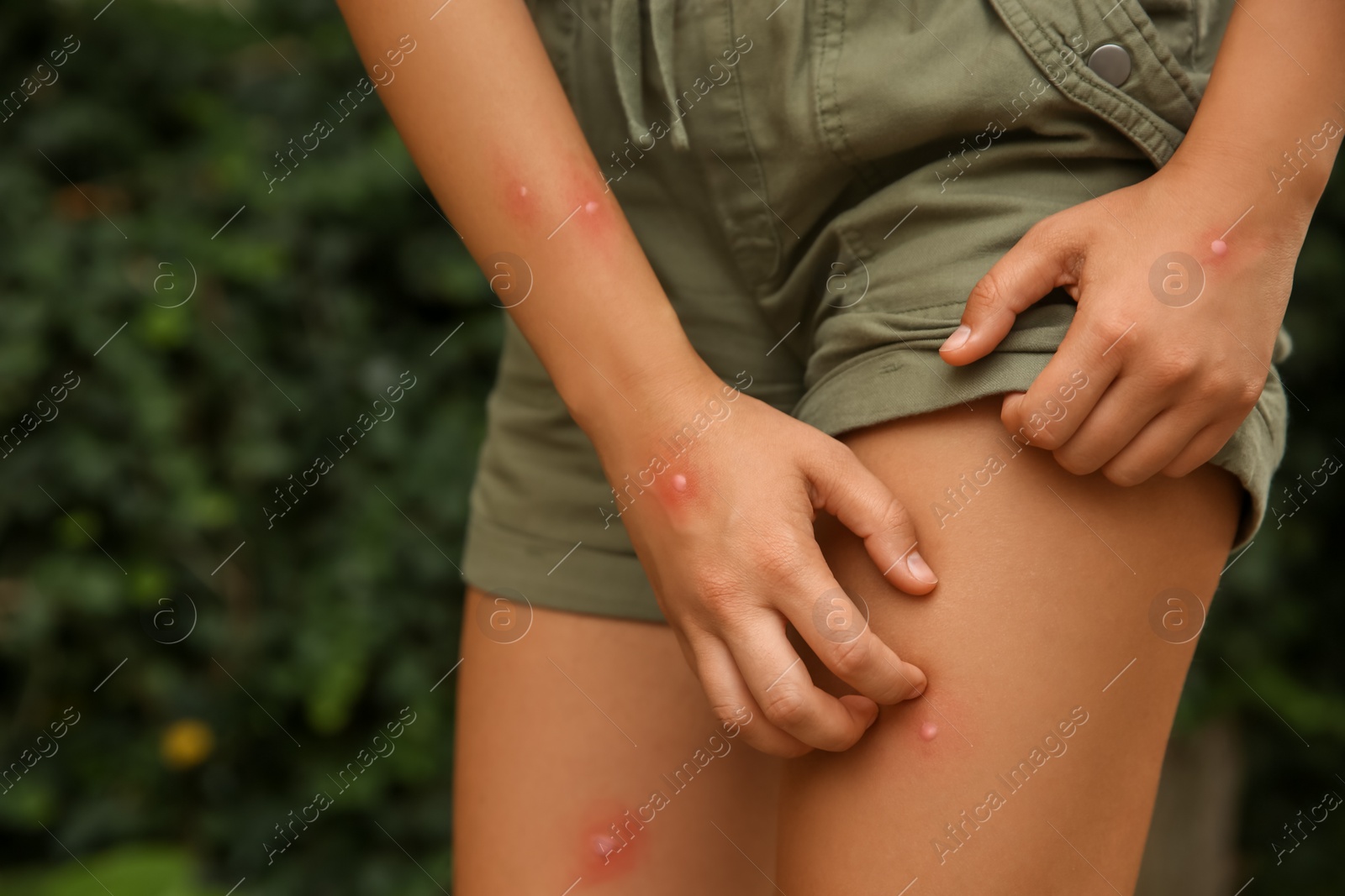 Photo of Woman scratching leg with insect bite in park, closeup