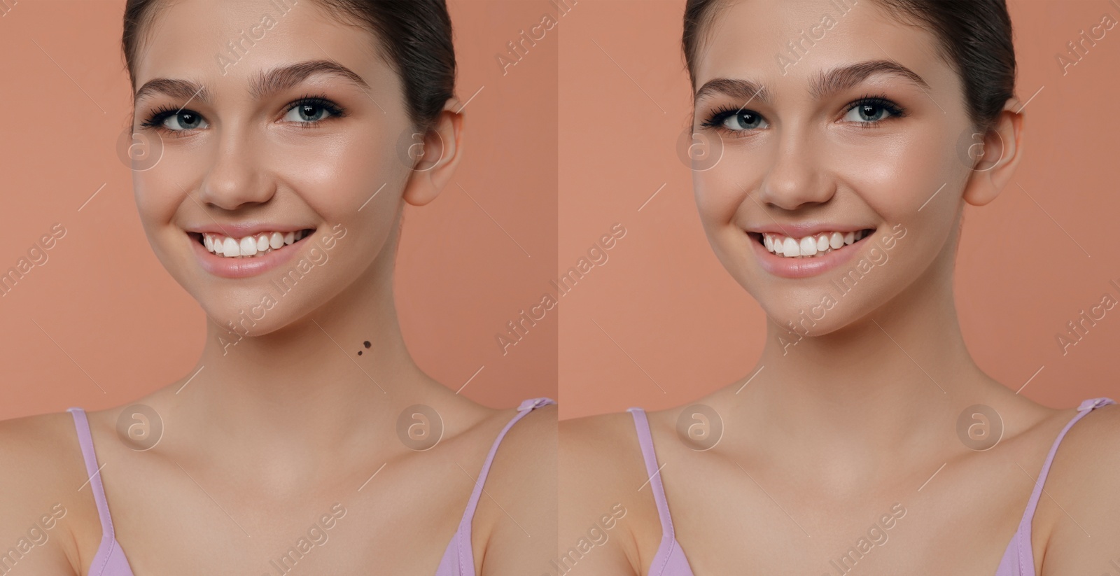 Image of Mole removal. Collage with photos of teenage girl before and after procedure on coral background