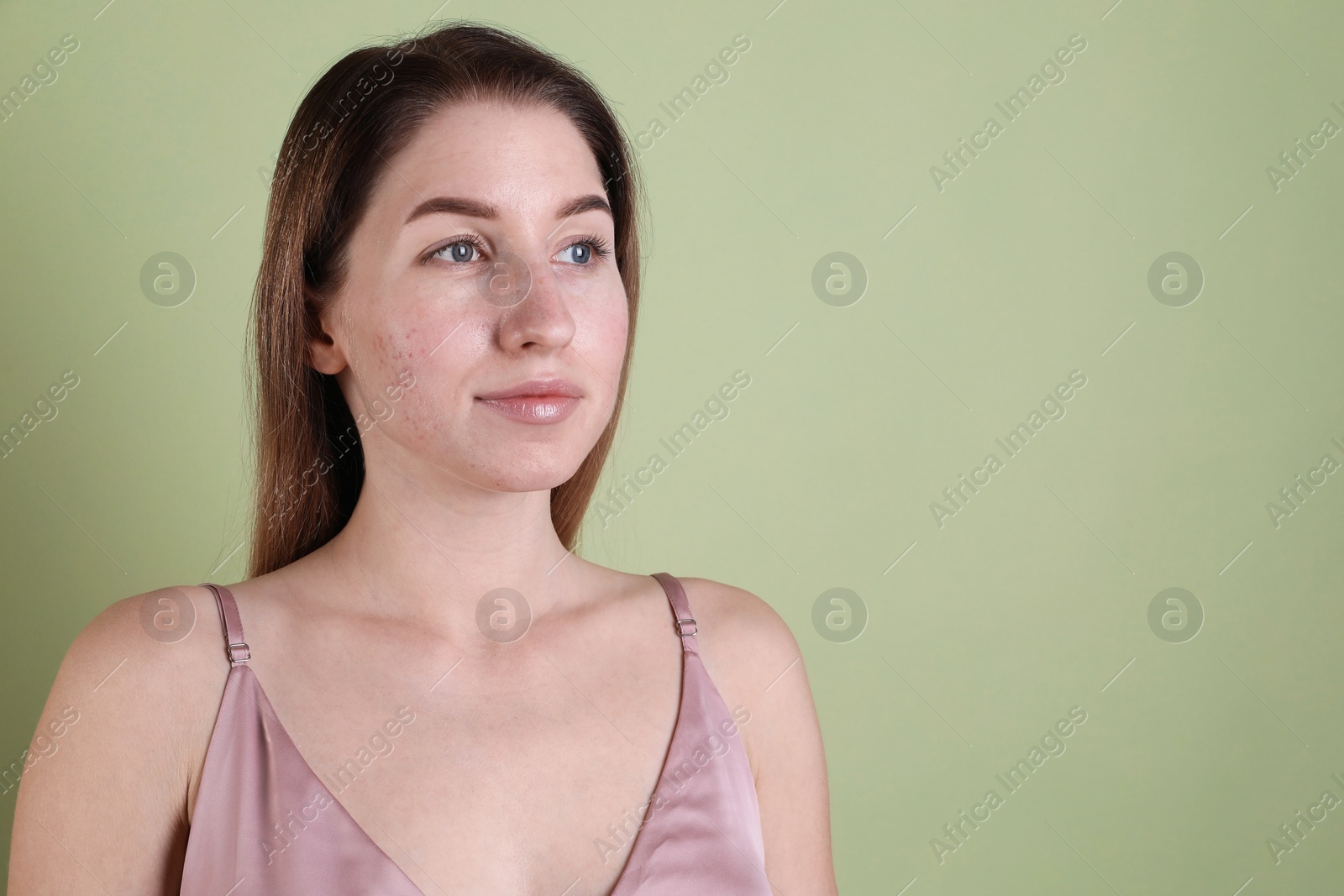 Photo of Young woman with acne problem on olive background. Space for text