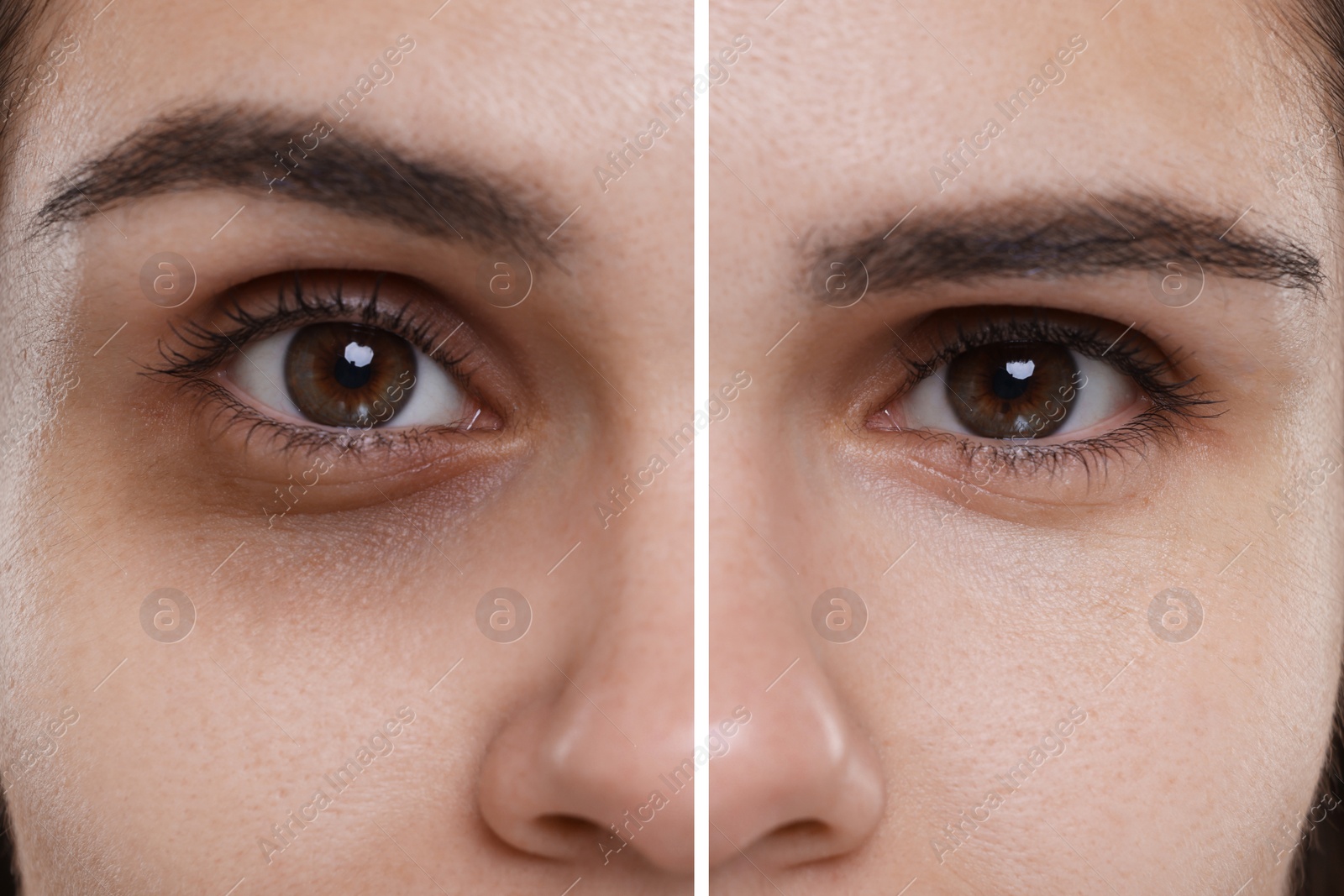 Image of Collage with photos of woman with dark circle under eye before and after treatment, closeup