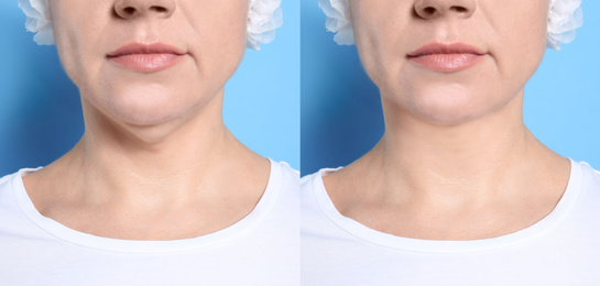 Image of Mature woman before and after plastic surgery operation on blue background, closeup. Double chin problem