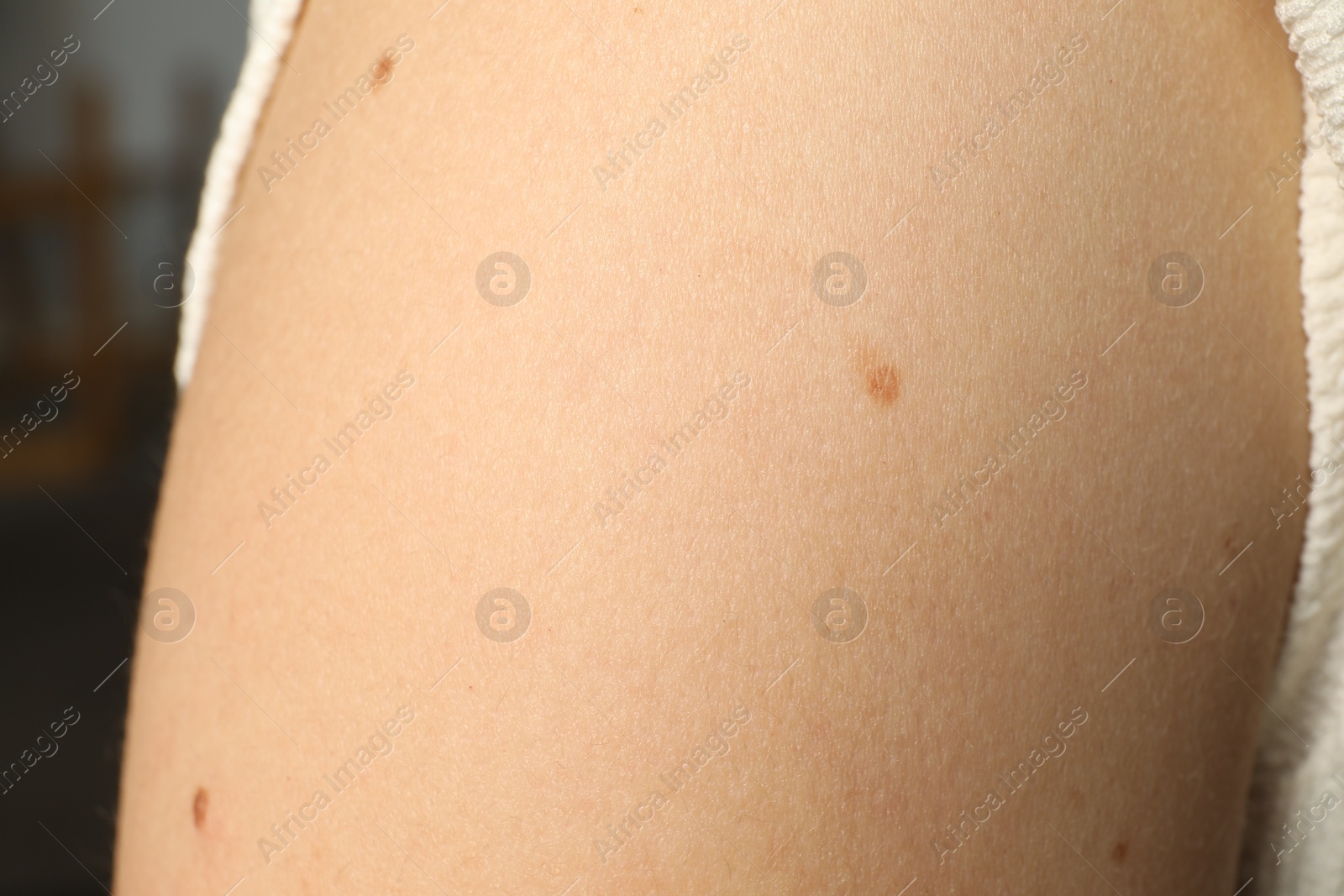 Photo of Closeup view of woman's body with birthmarks