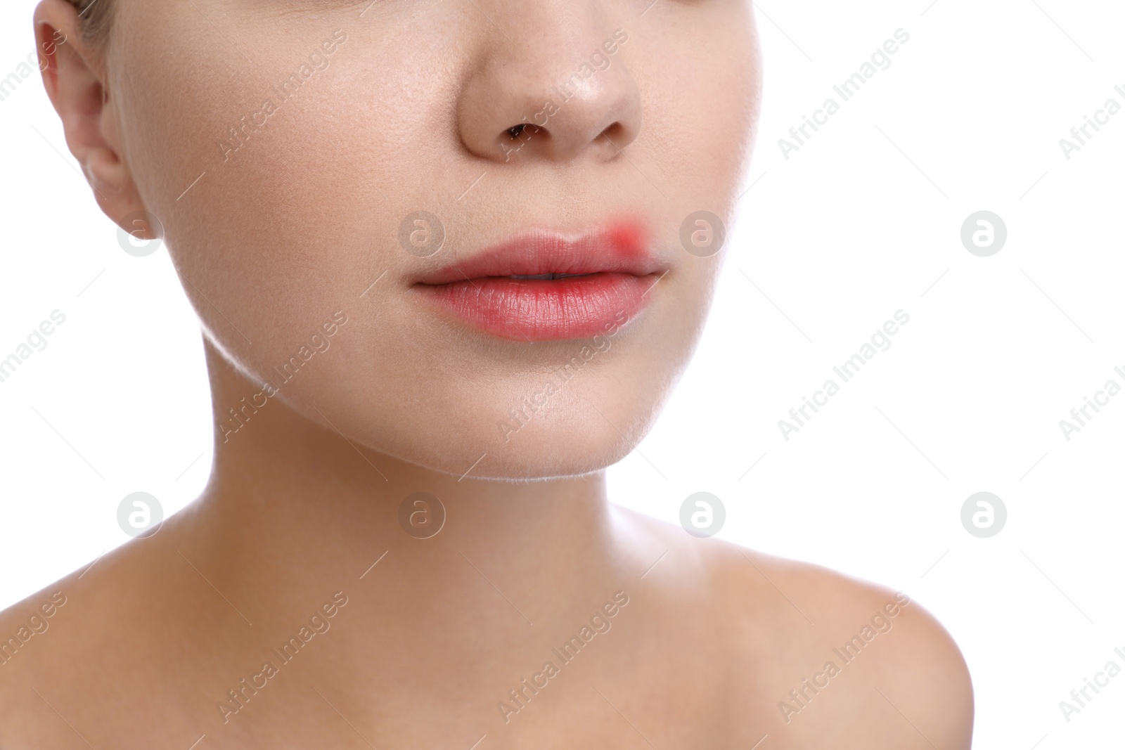 Photo of Young woman with cold sore on lips against white background, closeup