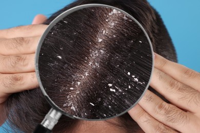 Man suffering from dandruff on light blue background, closeup. View through magnifying glass on hair with flakes