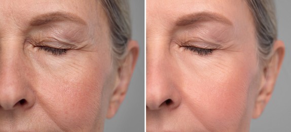 Image of Aging skin changes. Collage with photos of mature woman before and after cosmetic procedure on grey background, closeup