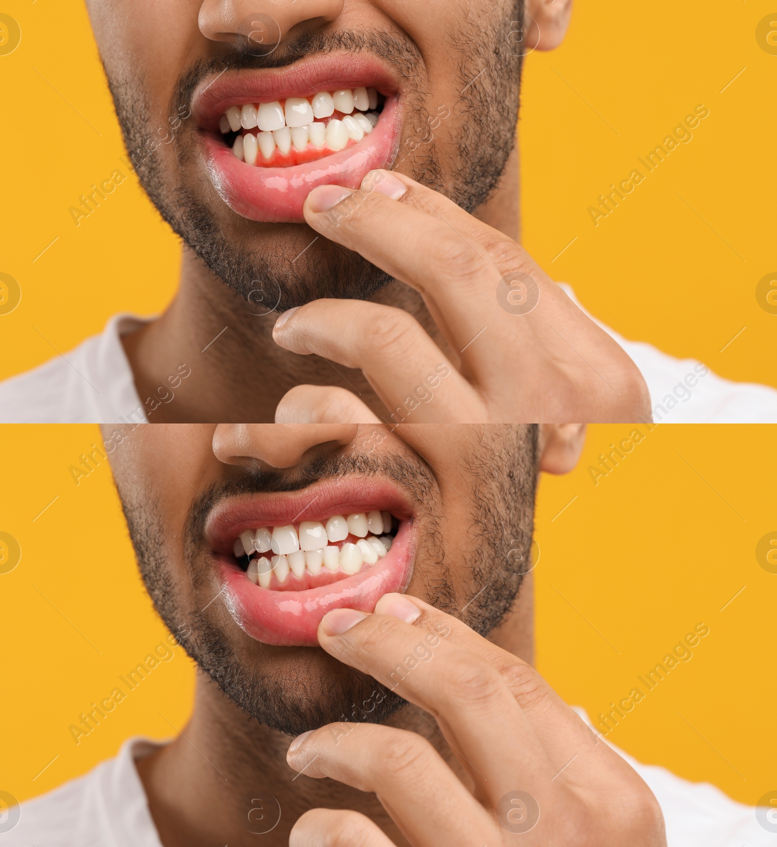 Image of Man showing gum before and after treatment on orange background, collage of photos