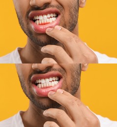 Image of Man showing gum before and after treatment on orange background, collage of photos