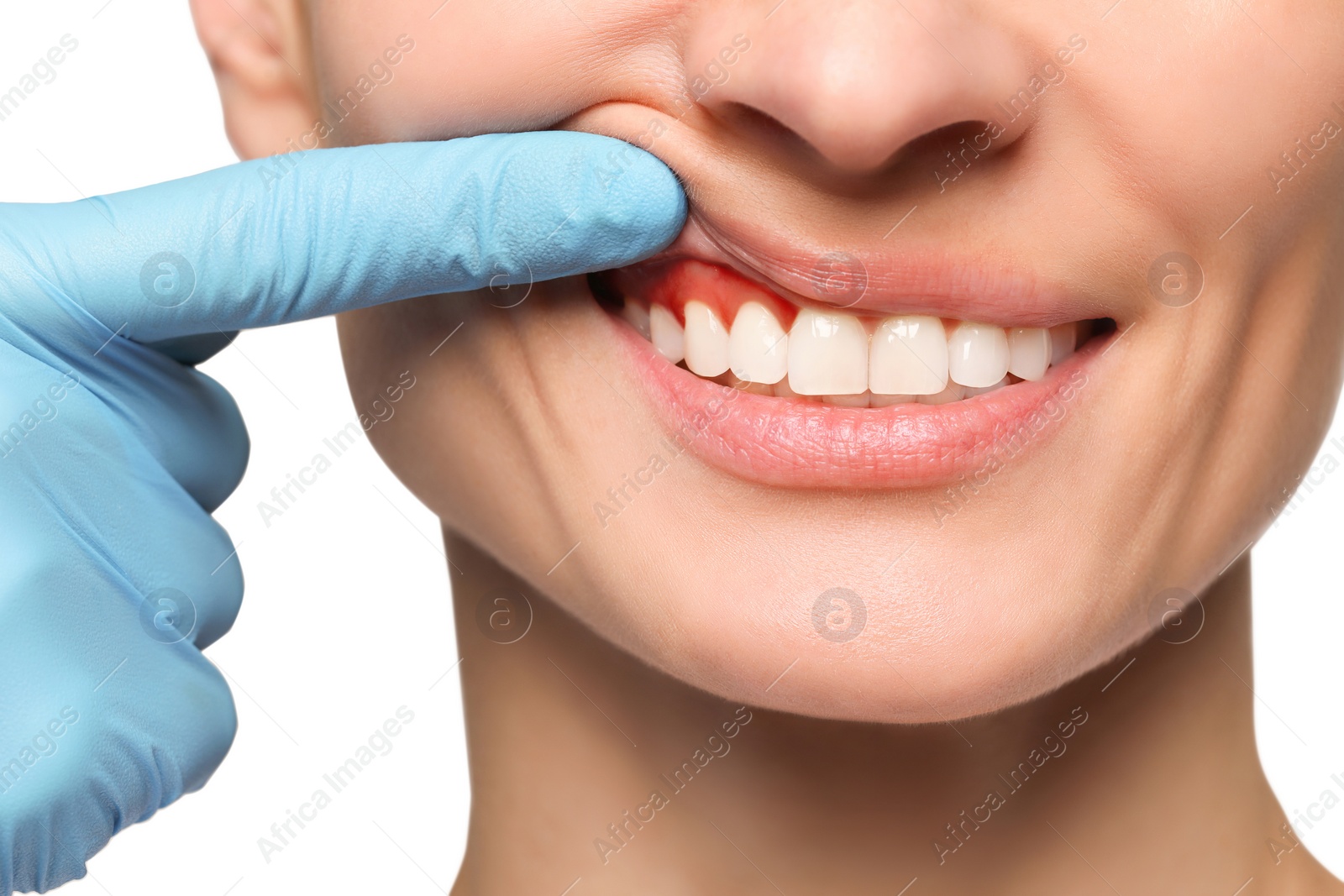 Image of Doctor examining woman's inflamed gum on white background, closeup