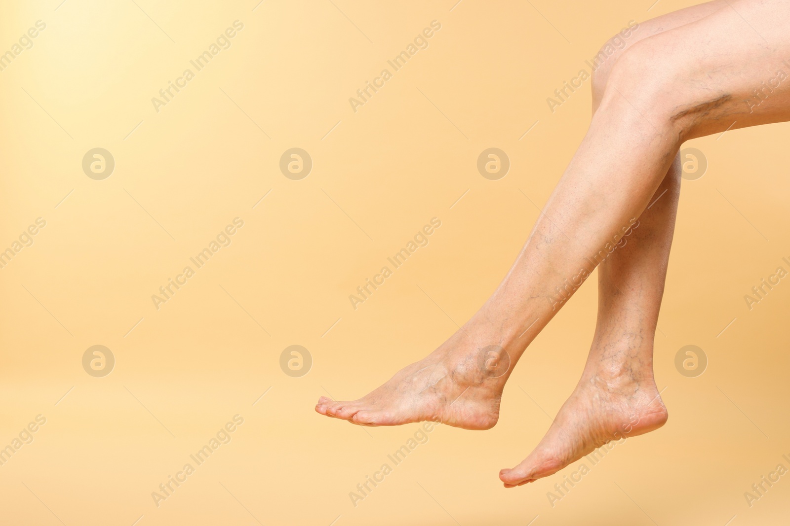 Photo of Closeup view of woman with varicose veins on yellow background. Space for text