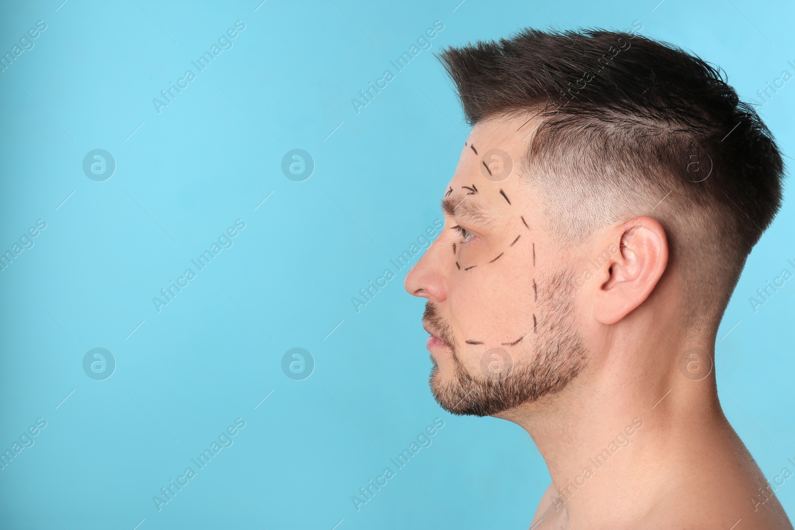 Photo of Man with marks on face for cosmetic surgery operation against blue background. Space for text