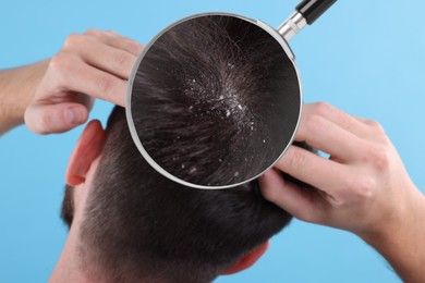 Man suffering from dandruff on light blue background, back view. View through magnifying glass on hair with flakes
