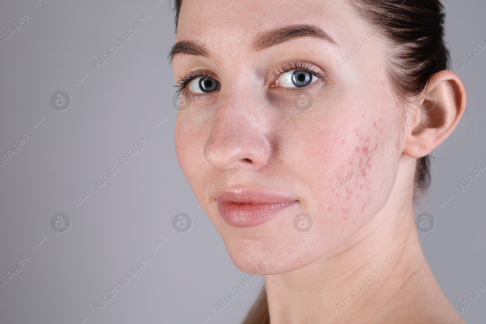 Photo of Young woman with acne problem on light grey background, closeup. Space for text