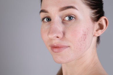 Young woman with acne problem on light grey background, closeup. Space for text