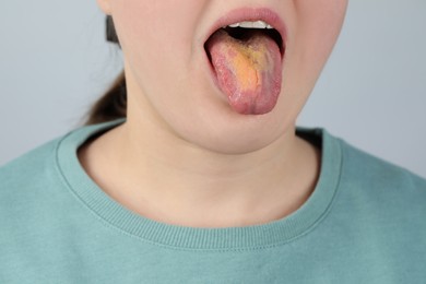 Photo of Gastrointestinal diseases. Woman showing her yellow tongue on light grey background, closeup