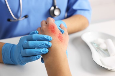 Photo of Doctor examining patient's burned hand at table, closeup