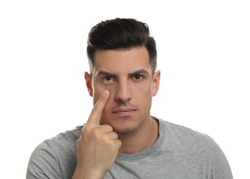 Man checking his health condition on white background. Yellow eyes as symptom of problems with liver
