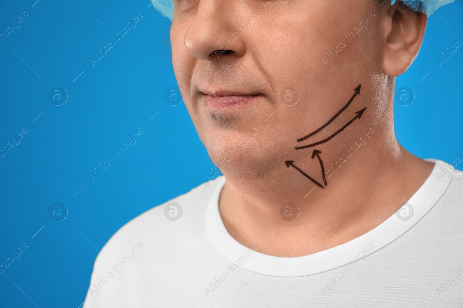 Photo of Mature man with marks on face against blue background, closeup. Double chin removal