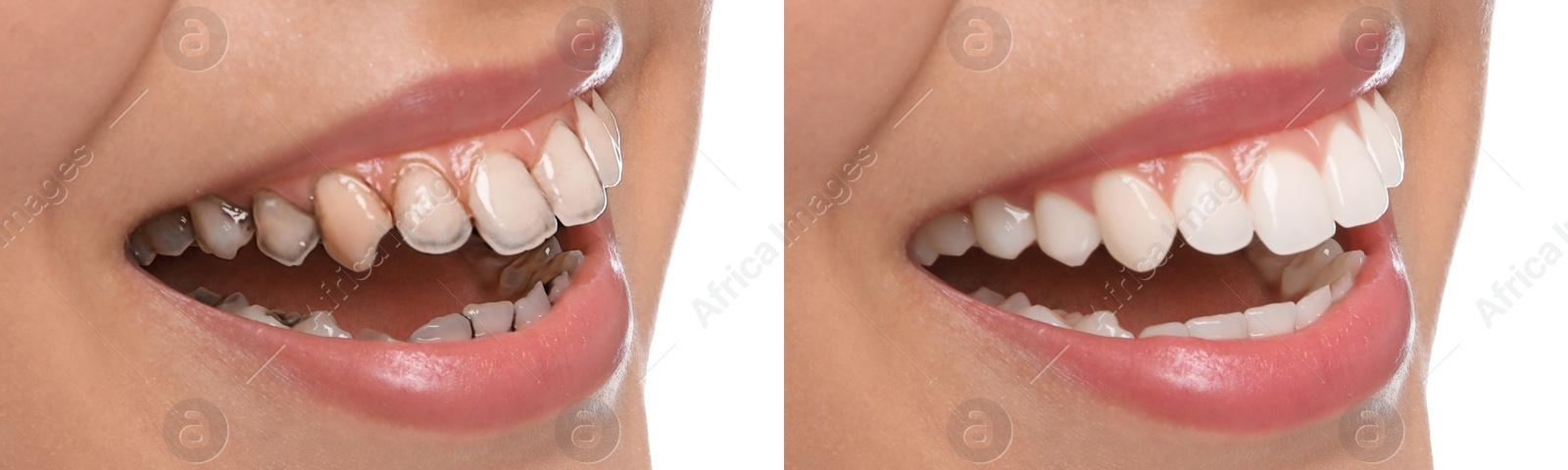 Image of Collage with photos of young woman before and after dental treatment on white background, closeup. Banner design