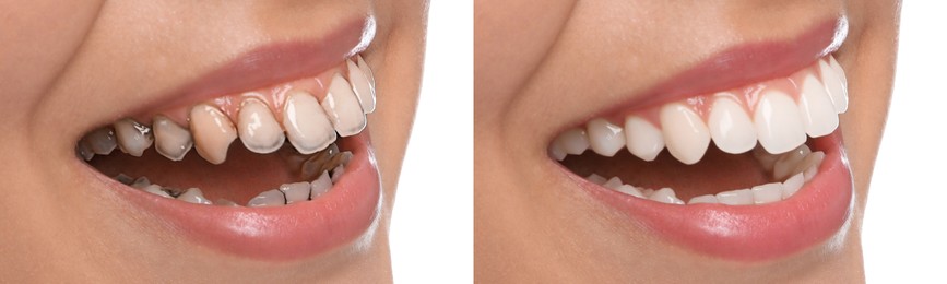 Collage with photos of young woman before and after dental treatment on white background, closeup. Banner design