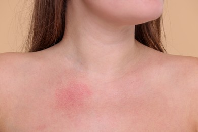 Photo of Closeup view of woman with reddened skin on her collarbone against beige background
