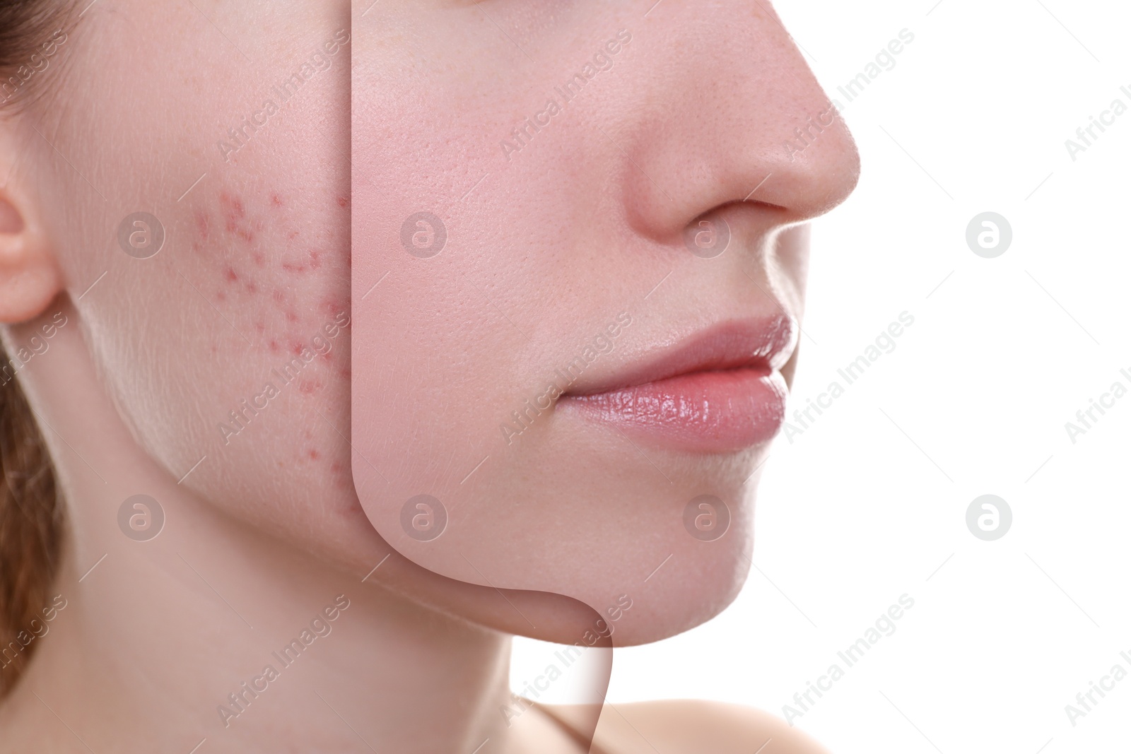 Image of Acne problem, collage. Woman before and after treatment on white background, closeup