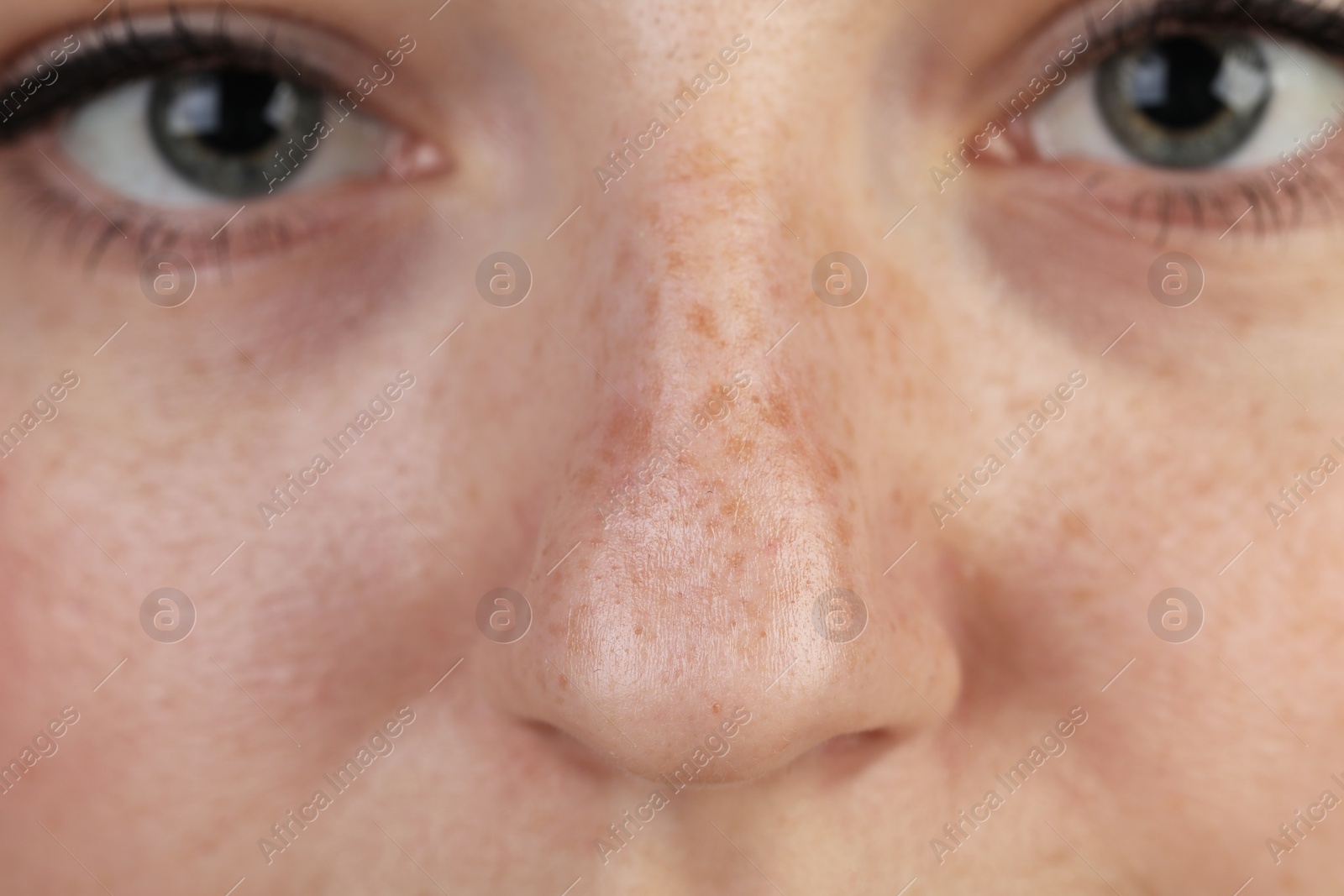 Photo of Closeup view of woman with dry skin