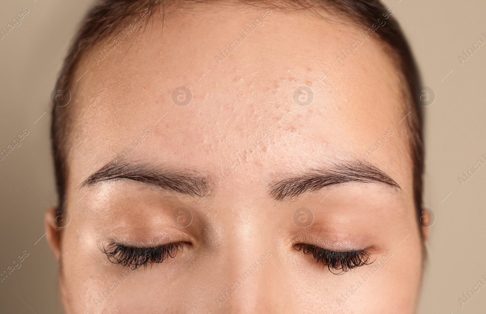 Photo of Teenage girl with acne problem on beige background, closeup