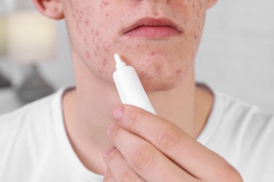 Photo of Young man with acne problem applying cosmetic product onto his skin indoors, closeup