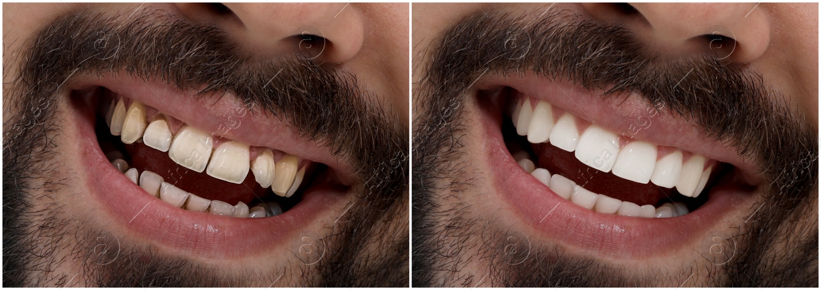 Image of Collage with photos of young man before and after dental treatment, closeup. Banner design