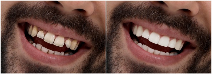 Image of Collage with photos of young man before and after dental treatment, closeup. Banner design