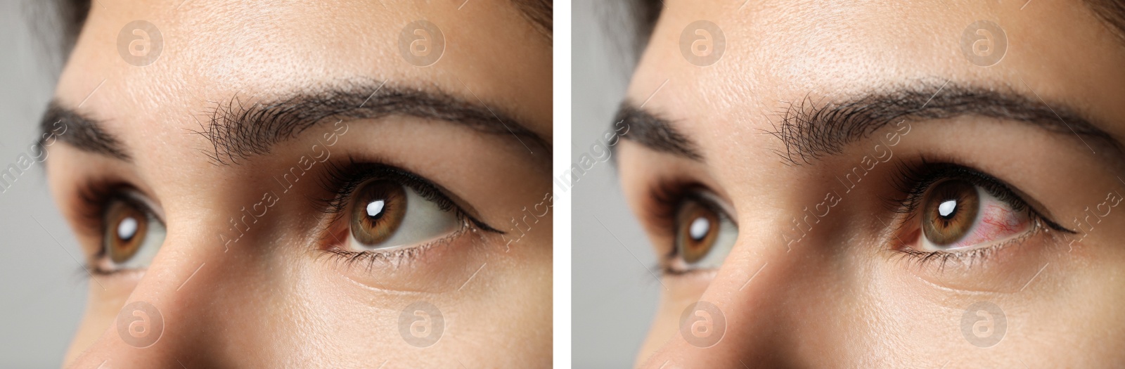 Image of Collage with photos of woman with inflamed and healthy eyes before and after treatment, closeup. Banner design