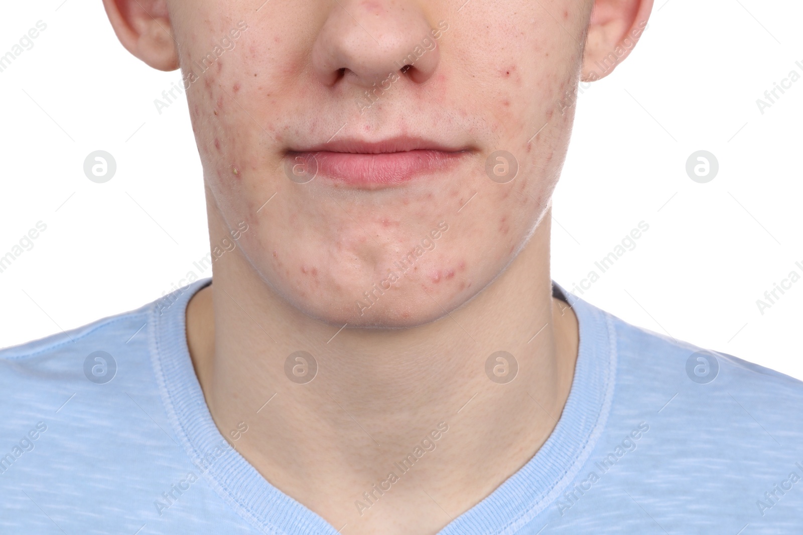 Photo of Young man with acne problem isolated on white, closeup