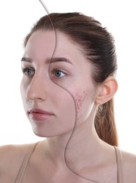 Acne problem, collage. Photo of woman divided into halves before and after treatment on white background