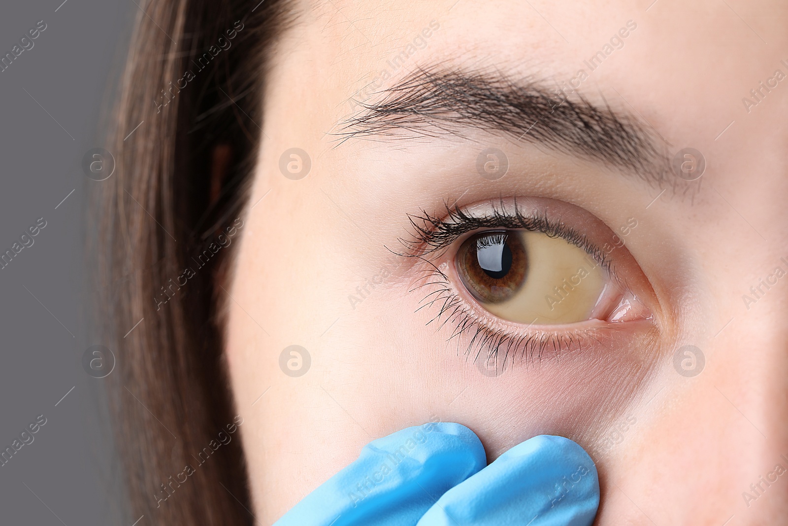 Photo of Doctor checking woman with yellow eyes on grey background, closeup. Symptom of hepatitis